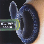 Laser Excimer